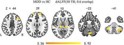 Dynamic Altered Amplitude of Low-Frequency Fluctuations in Patients With Major Depressive Disorder